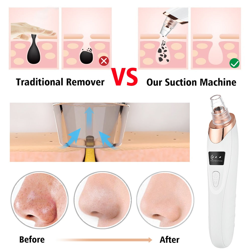 Blackhead Remover Vacuum Acne Pimple Black Spot Suction Electric Facial Pore Cleaner Skincare Exfoliating Beauty Instrument - Mammalook